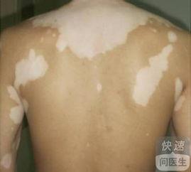 白癜风吃角瓜行吗,白癜风患者的天然食疗选择 第1张 白癜风吃角瓜行吗,白癜风患者的天然食疗选择 第1张